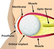 A cross-section diagram of a prosthetic eye